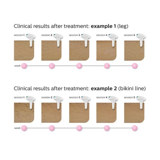 Lumea IPL 7000 Series SC 1997/00